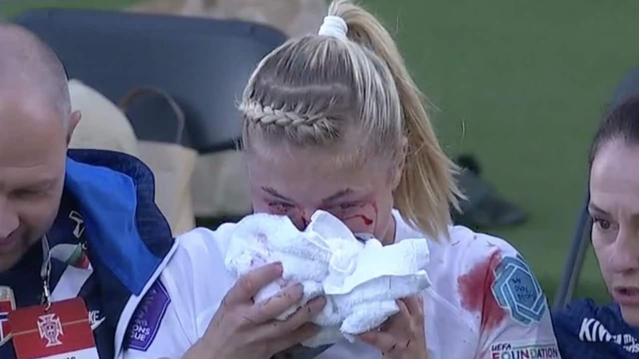 Record LFC Women signing suffers facial fracture 5 days before season opener