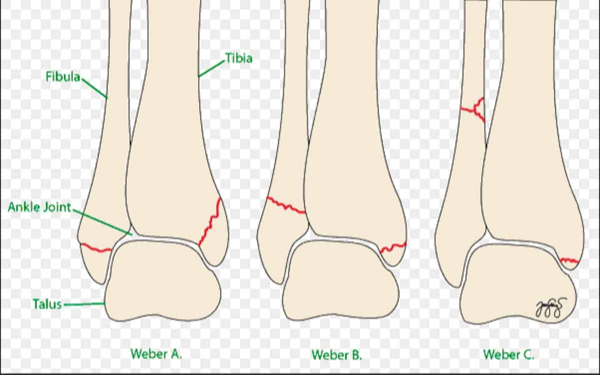 Щиколотки и лодыжки разница. Наружная лодыжка анатомия. Перелом лодыжки анатомия. Наружная лодыжка и малоберцовая кость. Лодыжка и берцовая кость.